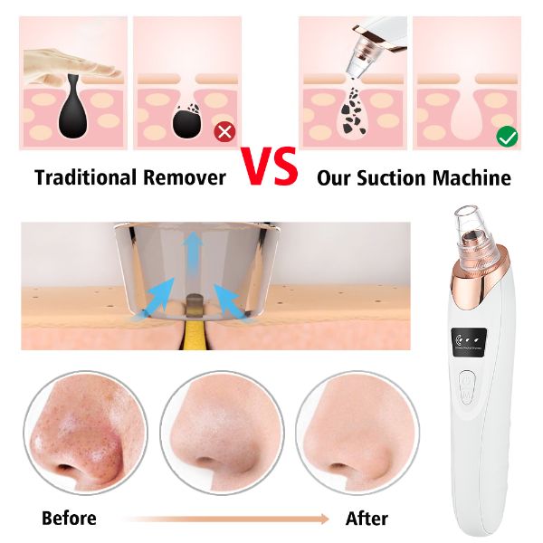 Facial Cleaning Blackhead Remover